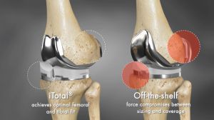 Customized Knee Implants